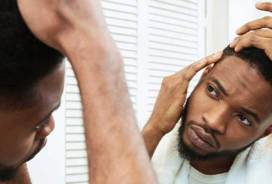 Best Hair Loss Treatments For Men